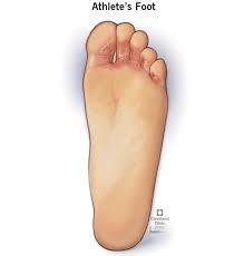 "Nail Fungus vs. Athlete’s Foot: What's the Difference?"